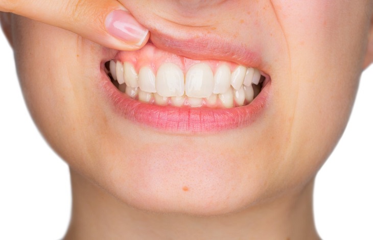 Why Some People Have Thinner Gums Than Others