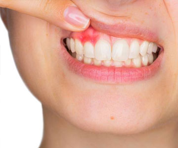 Gum / Periodontal Disease