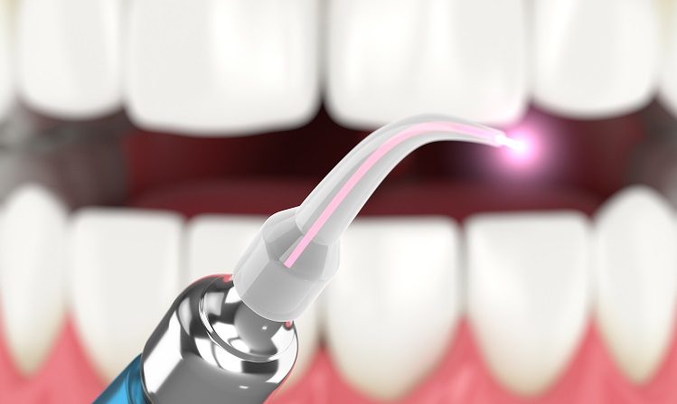 Everything you need to Know about laser dentistry