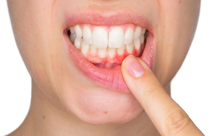 What is Gum Disease, and What Can I Do to Prevent It?