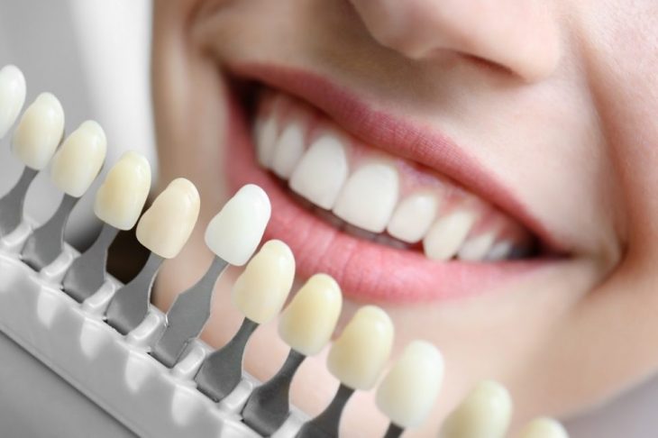What is the link between teeth whitening and gum recession?