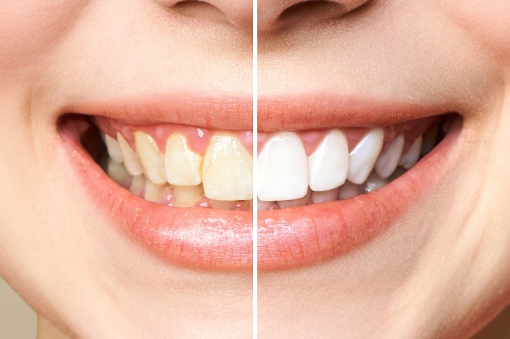 Debunking 9 Common Teeth Whitening Myths: The Expert Opinion