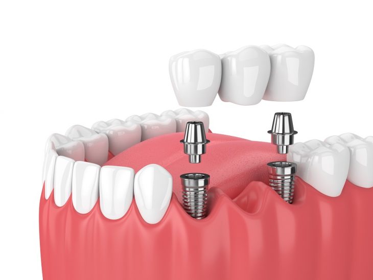 What Are the Key Differences Between Dental Crowns And Bridges?