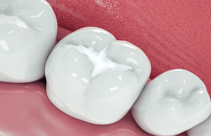 Achieving Natural Results The Advantages of White Fillings