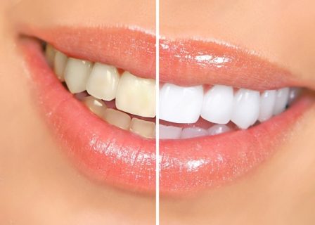 Transform Your Smile: Benefits of Professional Teeth Whitening at a Dental Clinic Maroubra