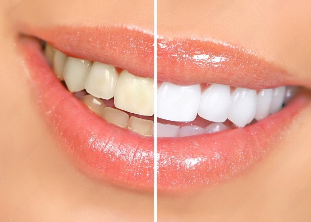 Benefits of Professional Teeth Whitening